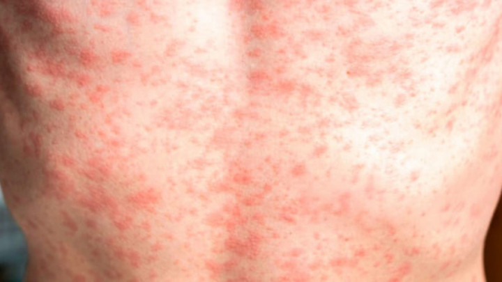 Vacunación, Clave para no Contagiarte de Sarampión, UNAM