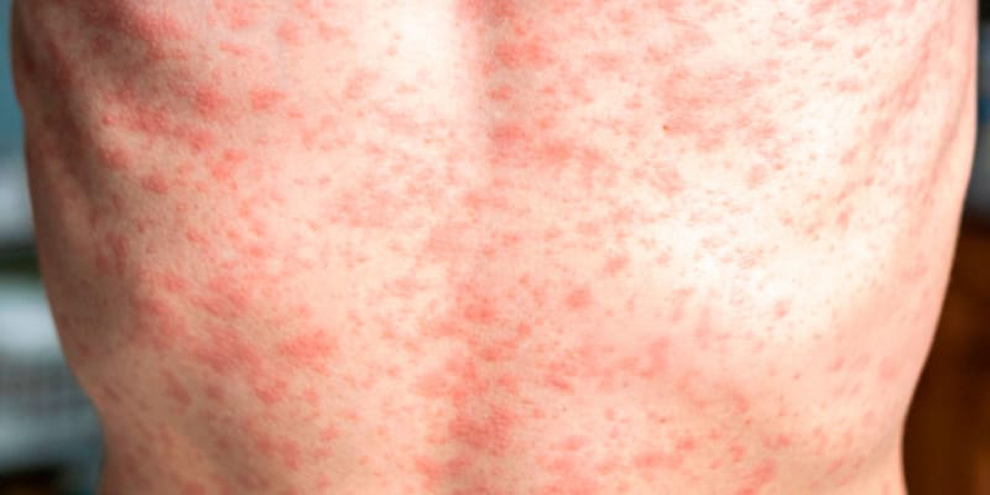 Vacunación, Clave para no Contagiarte de Sarampión, UNAM Vacunación, Clave para no Contagiarte de Sarampión, UNAM